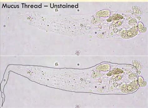 Mucus in urine normal range