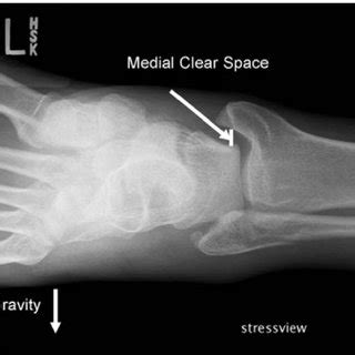 Technique for measurement of the medial clear space (MCS) on stress... | Download Scientific Diagram