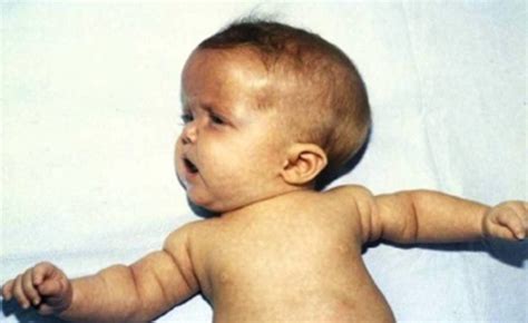 Achondroplasia Infant – Clinical Eye Openers