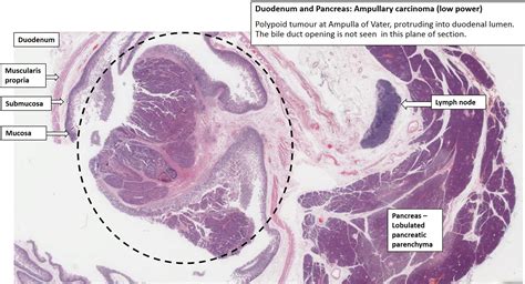 Ampulla Of Vater Histology