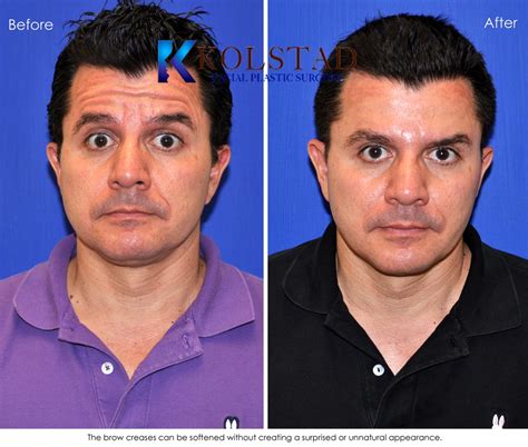 Forehead Botox in San Diego for Men Before & After Gallery 22 | Dr. Kolstad - San Diego Facial ...