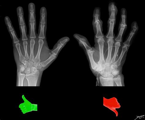 Osteoarthritis | Hands