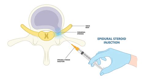 Epidural Steroid Injection