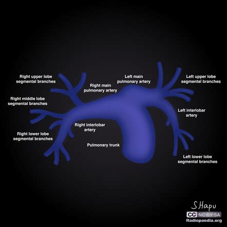 Pulmonary arteries (illustrations) | Radiology Case | Radiopaedia.org