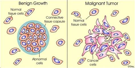 Malignant Neoplasm - A Detailed Information & Guide