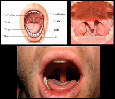 Uvula Infection Treatments