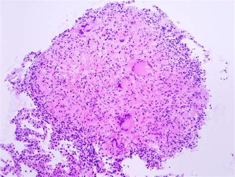 Tuberculosis Granuloma