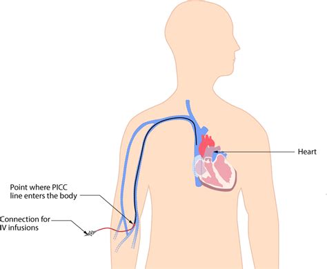 picc – Clinical Procedures for Safer Patient Care