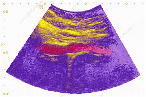 Calcific aortic atheroma, ultrasound - Stock Image - C030/6261 - Science Photo Library