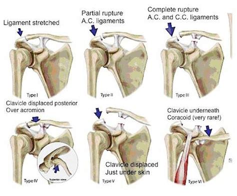 Pictures Of Acromioclavicular Joint