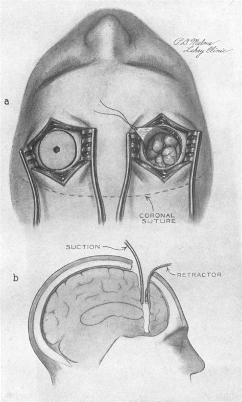 Lobotomy Procedure Steps