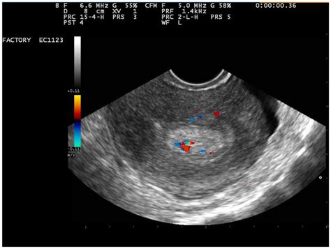 Uterine Polyps Ultrasound