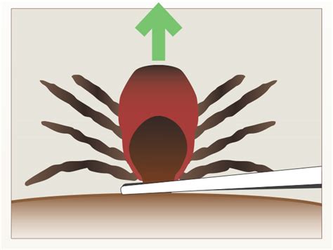 tick-removal-1t51jfz | The ABCs of School and Childcare Pest Management