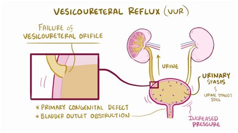 VIDEO Acute pyelonephritis urinary tract infection causes, symptoms & pathology - YouTube