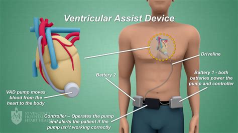 Ventricular Assist Device