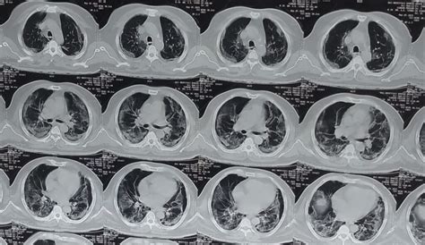 HRCT CHEST /HRCT THORAX - Bloggjhedu