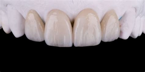 Different Types Of Veneers: Advantages & Disadvantage