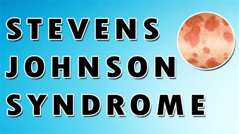 Steven-Johnson Syndrome: What Is, Causes, Symptoms, and Diagnosis