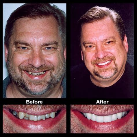 Crooked Teeth Treatment | Oppenheim Signature Smiles