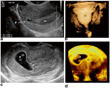 Interstitial Pregnancy | Obgyn Key