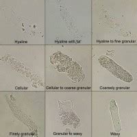 Casts in Urine | Medical Laboratories