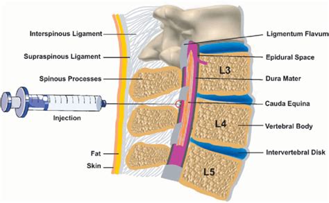 Epidural Injections For Neck Pain | Back Pain | PDI