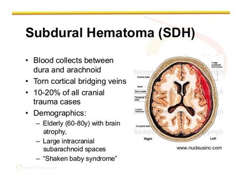 diagram of subdural hematoma symptoms - Google Search | Subdural ...