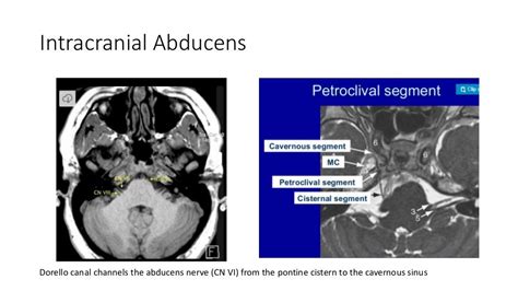 Differential Diagnosis in Lateral Rectus Palsy