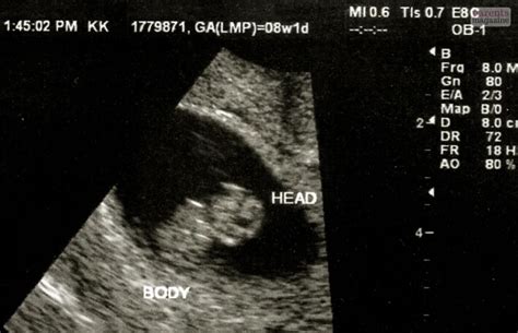 Ultrasound At 8 Weeks Pregnant