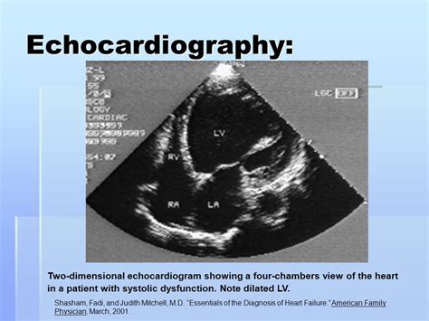 Echocardiogram Congestive Heart Failure