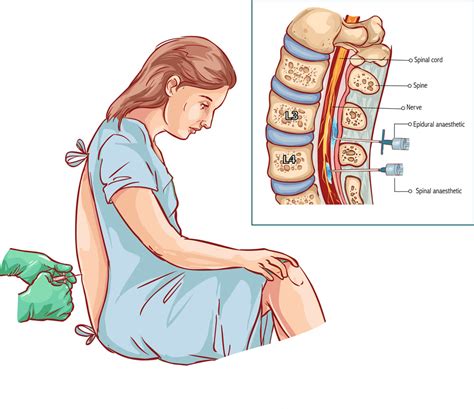 Epidural: Definition, Procedure, Medication, Injection, Pain, & Side ...