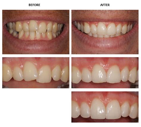 Inman Aligner before and after pictures - Inman Aligner