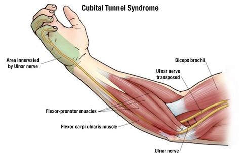 Cubital Tunnel Syndrome Test - Precision Medical Group