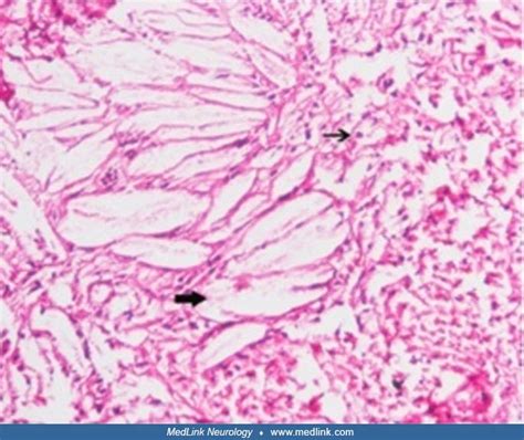 Xanthoma Planar Causes Symptoms Treatment Xanthoma Planar