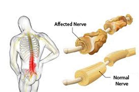 Guillain-Barré Syndrome (GBS) | Plexus