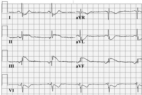 File:ECG atrial rhythm now sr.png - ECGpedia