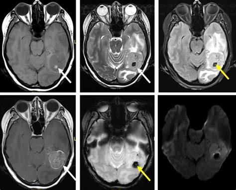 Anaplastic astrocytoma – Radiology Cases