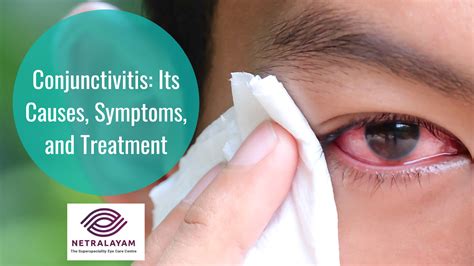 Conjunctivitis Causes Symptoms Precautions And Treatments Conjunctivitis Prevention – NBKomputer