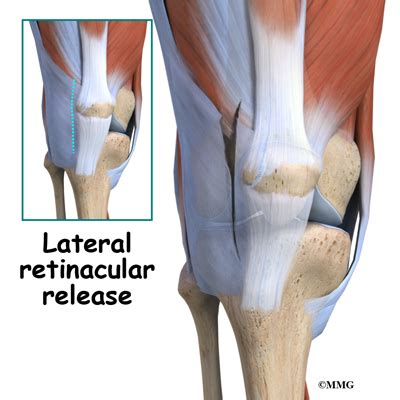 Bipartite Patella | eOrthopod.com