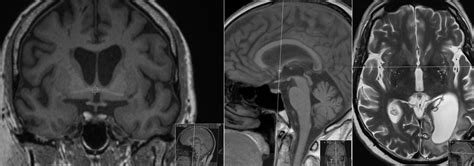 Anterior Commissure