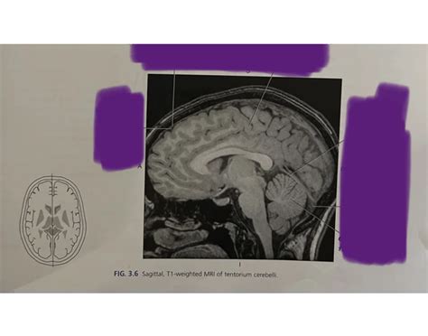 Sagittal T1 Weighted MRI of Tentorium Cerebelli Quiz