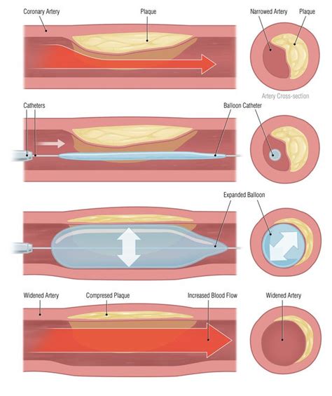 Angioplasty Guide