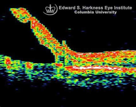 Retinoschisis (OCT Study) | Vagelos College of Physicians and Surgeons