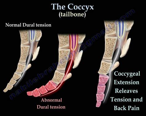 Coccyx pain