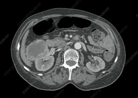 Kidney cancer, CT scan - Stock Image C026/7597 - Science Photo Library