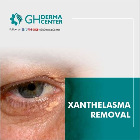 Xanthelasma occurs due to lipid abnormality and occurs with yellow plaques on the eyes. If you ...