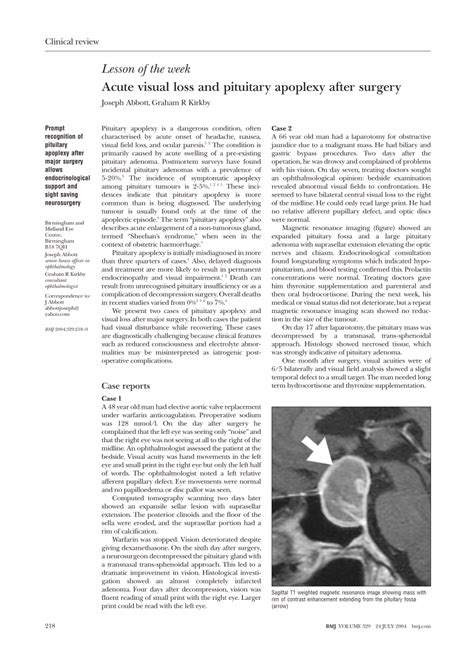 (PDF) Acute visual loss and pituitary apoplexy after surgery