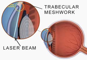 Introduction To Laser Trabeculoplasty (LT) | New-Glaucoma-Treatments.com