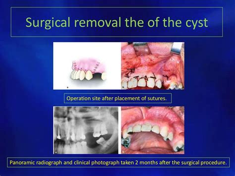 Odontogenic cysts