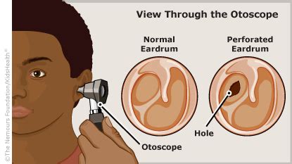 Perforated Eardrum | Nursing tips, Nemours, Childrens health